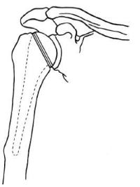 Синдром «замороженного» плеча. Терапия триггерных точек для преодоления боли и восстановления диапазона движений