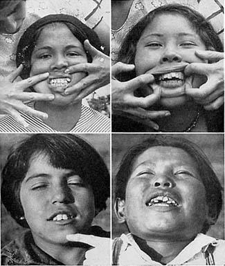 Питание и физическая дегенерация. Почему у примитивных народов красивые и здоровые зубы, а у современного человека нет?. Вестон  Прайс. Иллюстрация 5